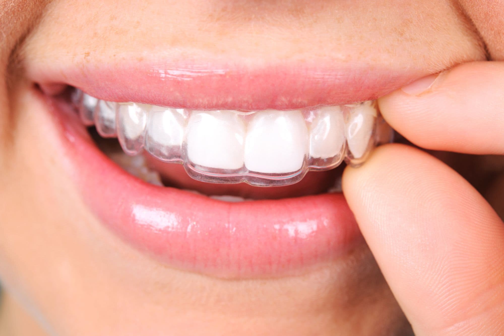 How Ceramic Braces Work to Straighten Your Smile